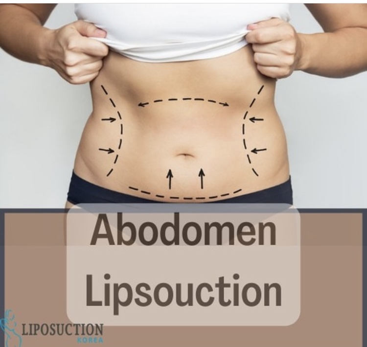 liposuction-cost