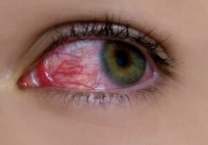 Read more about the article Top 10 Deceptive Myths About  Conjunctivitis (Pink Eye)