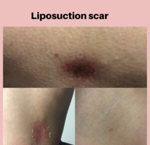 Read more about the article Liposuction Scars – How to Avoid Them